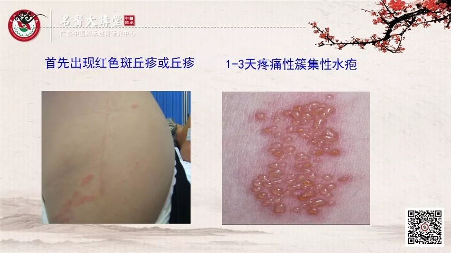 带状疱疹1.jpg