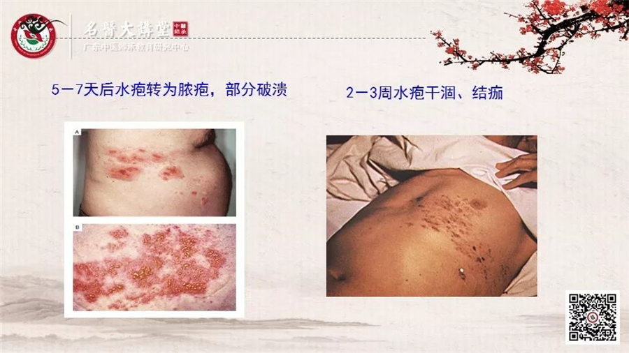 带状疱疹2.jpg